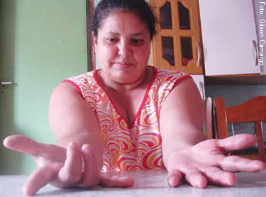 Loreci, 40 anos, aguarda aposentadoria: depressão, dor e imobilidade das mãos