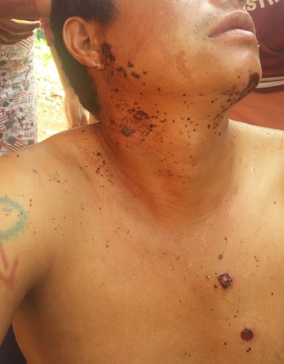Guarani Kaiowá ferido durante ataques às retomadas em Dourados
